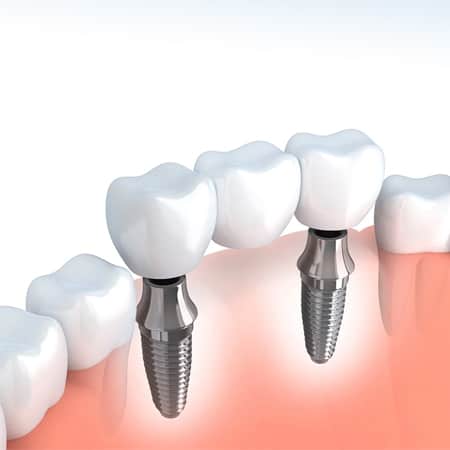dental-bridges_61b25c43ff86fe27b05cbc92012a93e7