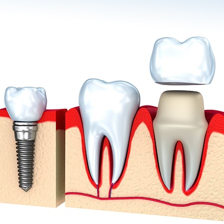dental-implants