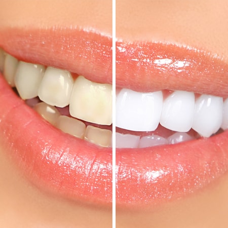 teeth_271e593f86309744df15e86c60d91edd